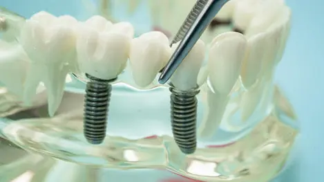 Dental implant model showing two metal implants supporting artificial teeth, with a pair of tweezers adjusting one tooth on a transparent base.