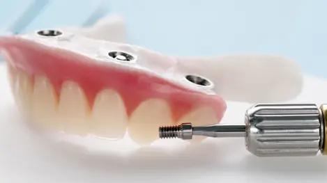 Dental prosthesis with pink gum and artificial teeth, showing three metal screw holes for implants, alongside a dental tool holding a small implant screw.
