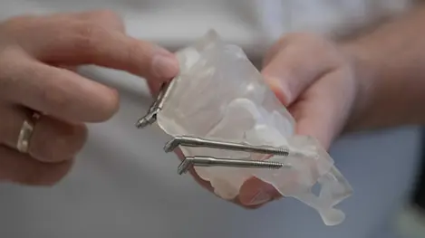 Transparent dental model held in hands, showing three angled metal implants embedded in the jaw structure.